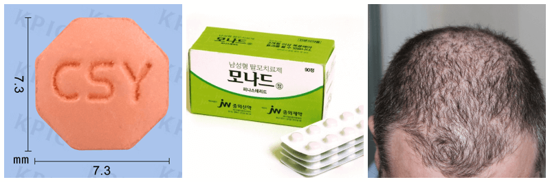 모나드정, 남성 탈모 사진