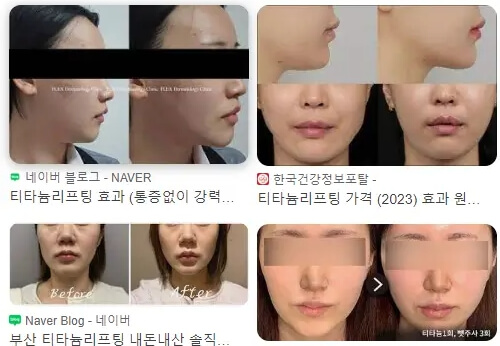 티타늄리프팅
