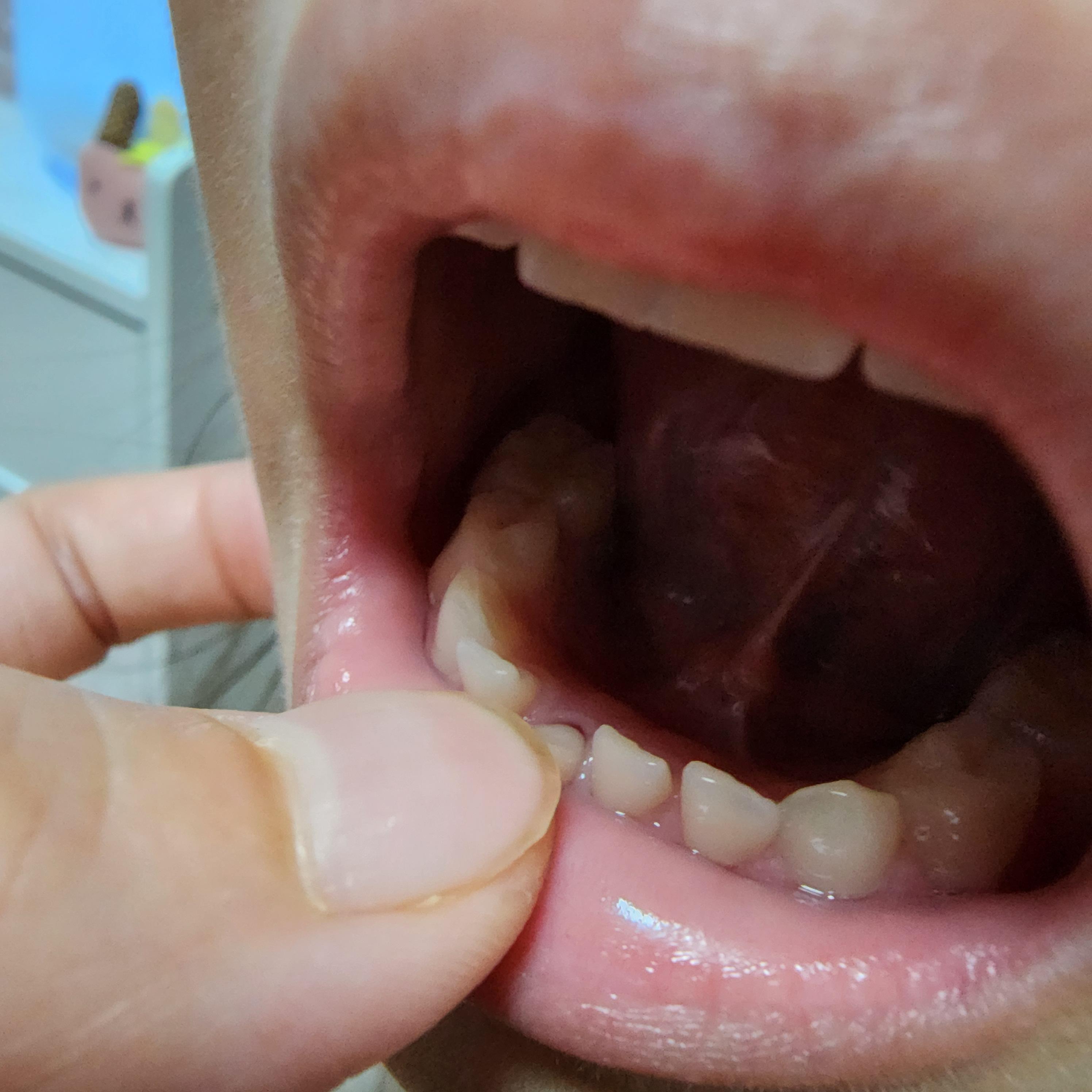 안아프게이빨뽑기