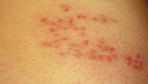 대상포진에 좋은 음식 깔끔정리~