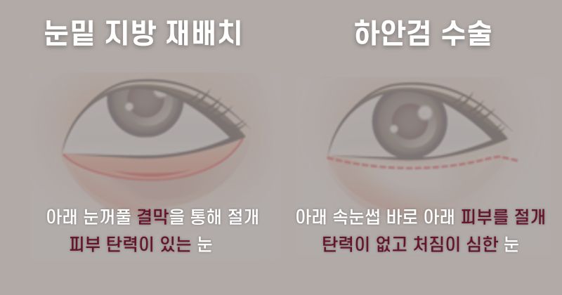 눈밑 지방 재배치 하안검 수술 차이