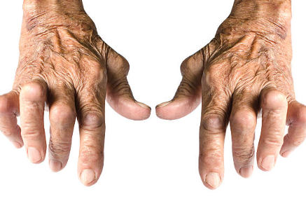 류마티스 관절염