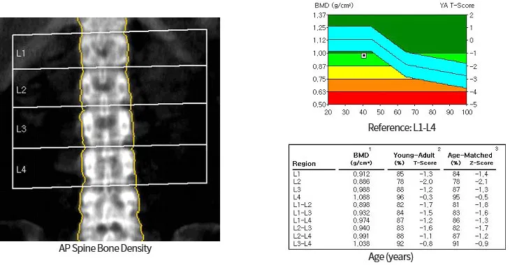 골밀도 검사 수치 골밀도 높이는 방법 간단 정리_1