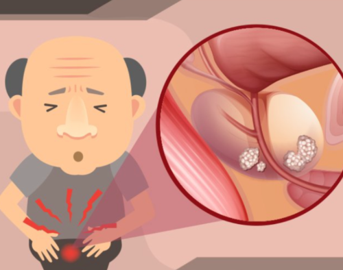 전립선암의 원인