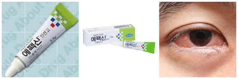에펙신 안연고, 결막염 사진