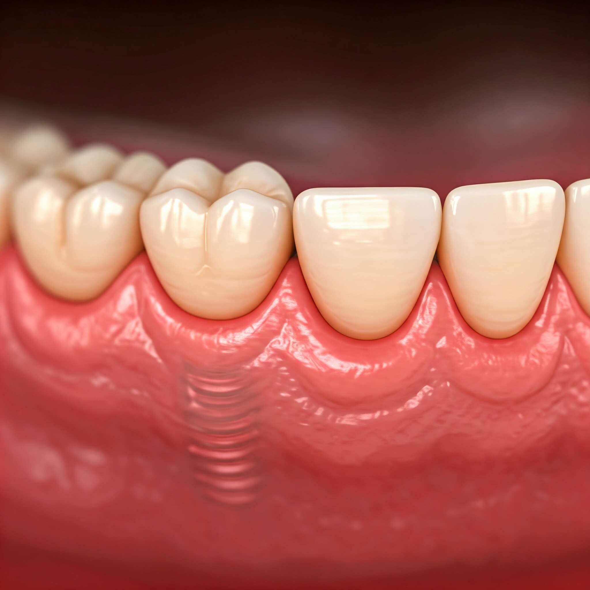 peri-implantitis. 임플란트 주위에 염증이 생긴 모습