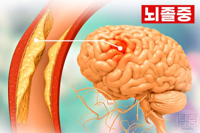 흰머리 나는 부위 뇌졸중 흰머리 부위별 원인