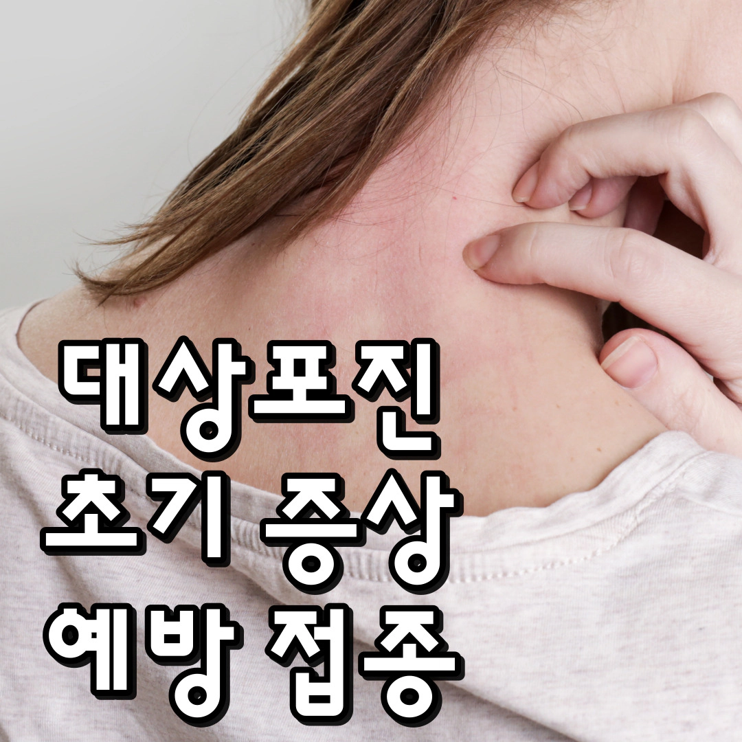 [대상포진] 초기 증상-증상-예방 접종