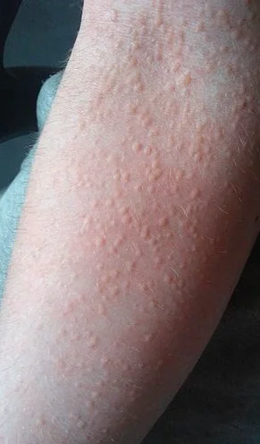 콜린성 두드러기 증상 예시