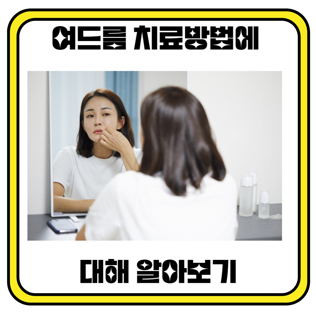 여드름 치료방법에 대해 알아보기