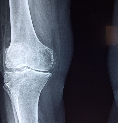 콘드로이친 1200mg, 효능, 부작용