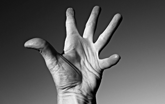 류마티스 관절염