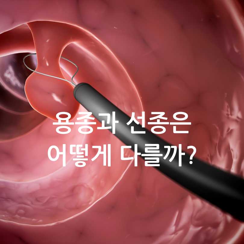 대장 용종과 선종의 차이점부터 예방법