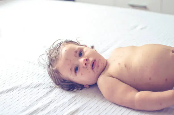 홍역(Measles)의 전 세계 확산과 예방 방법