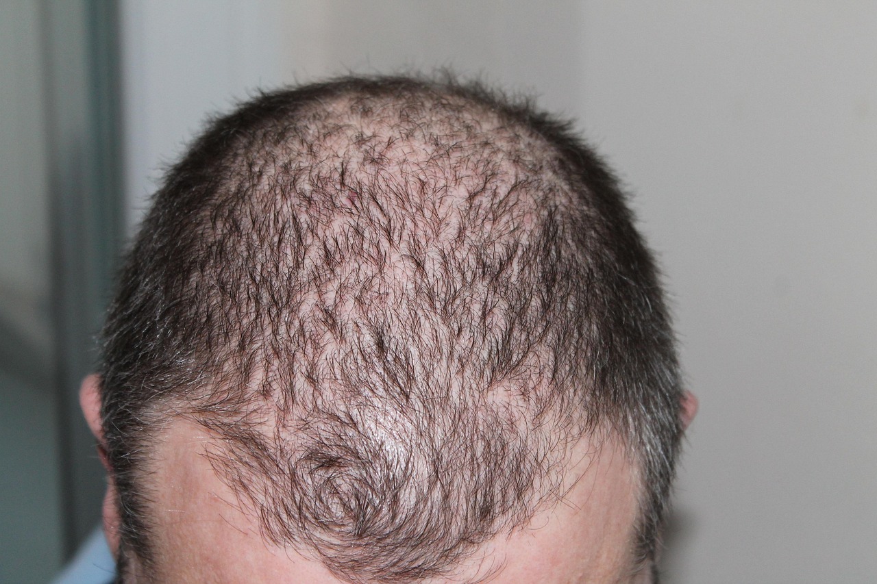 탈모, hair loss