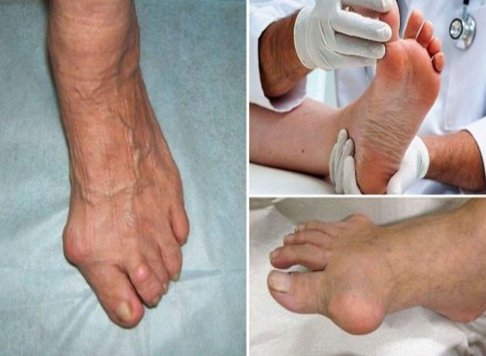 무지외반증 심각