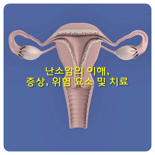 난소암의 이해&#44; 증상&#44; 위험 요소 및 치료