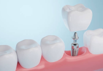 임플란트는 치아 건강을 위한 선택