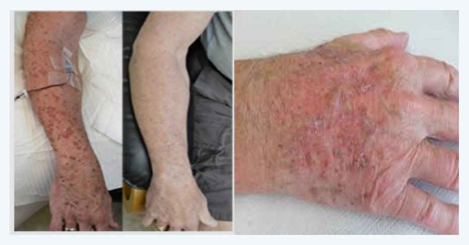 한공각화증, 광선각화증