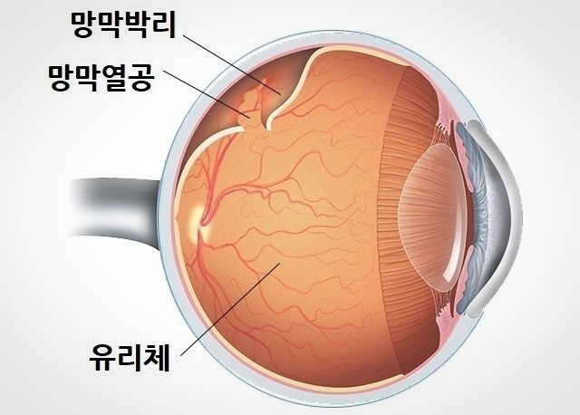 실명을 부르는 4대 망막질환 – 황반변성, 당뇨망막병증, 망막박리, 망막혈관폐쇄 총정리 관련 사진