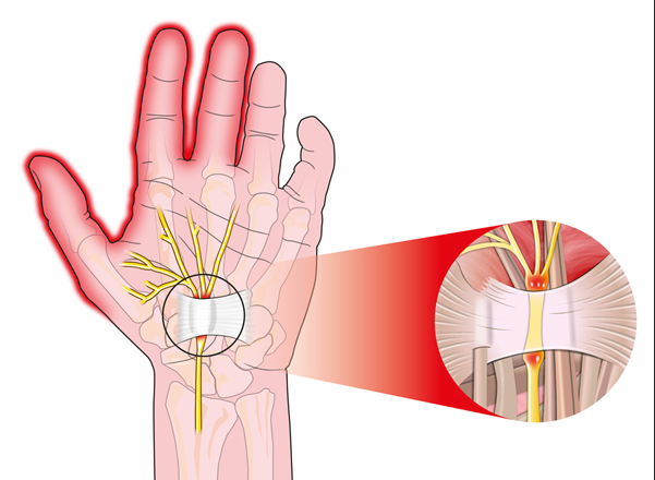 손목 통증 원인