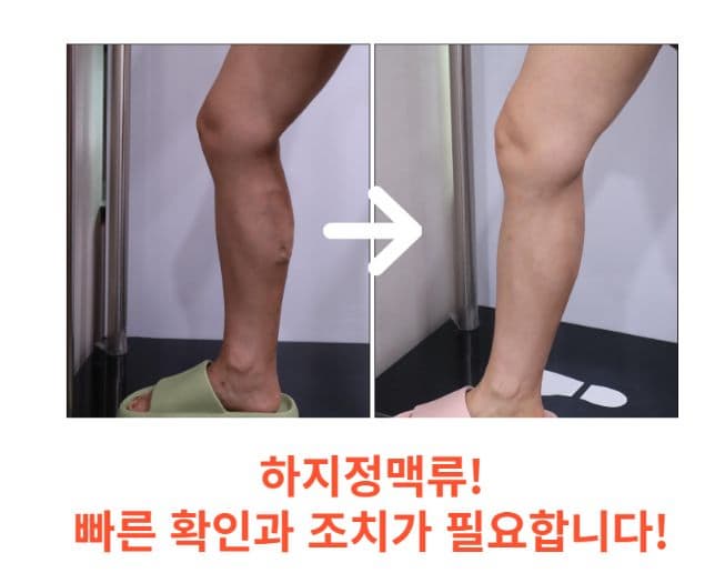 하지정맥류 증상