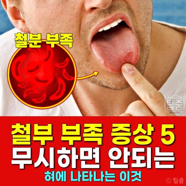 철분 부족 증상 설염