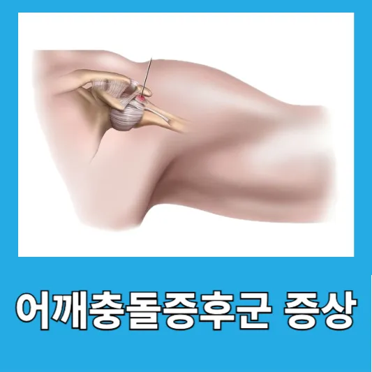 어깨충돌증후군 증상