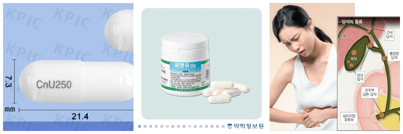 씨앤유캡슐, 담석 사진