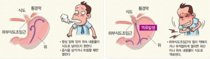 역류성 식도염 1