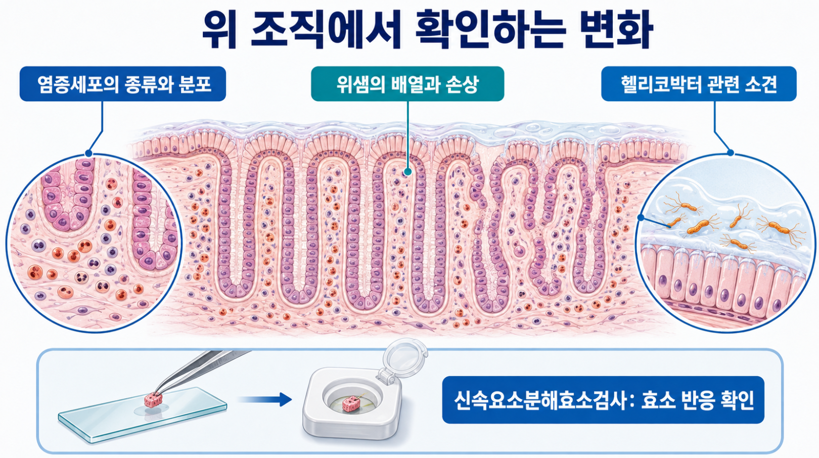 위 조직에서 확인하는 염증세포와 위샘 배열 및 헬리코박터 관련 소견