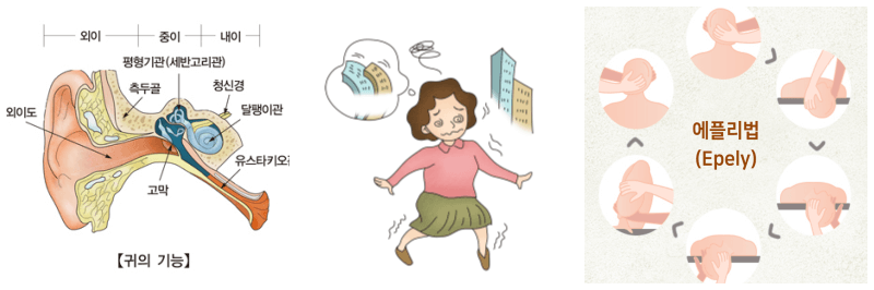 귀 내부, 어지러움증, 에플리법 사진