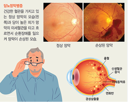 "안경값 아끼세요!" 2026년 어르신 안경 보조금 신청 방법과 자격