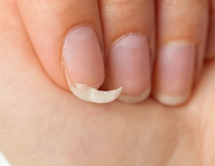 손톱 갈라짐의 이유