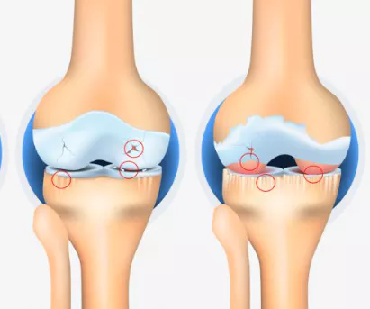 무릎-관절염에-좋은-운동-주의사항