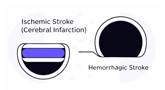 뇌경색 치료과정
