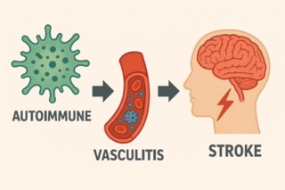 자가면역질환이 뇌졸중으로 이어지는 과정을 도식화(출처: 자체제작)