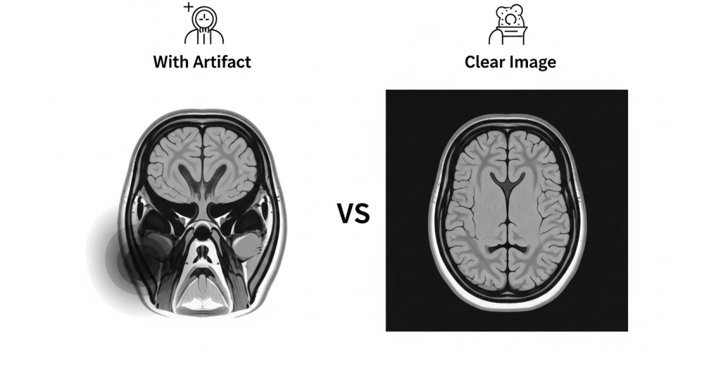 mri 임플란트