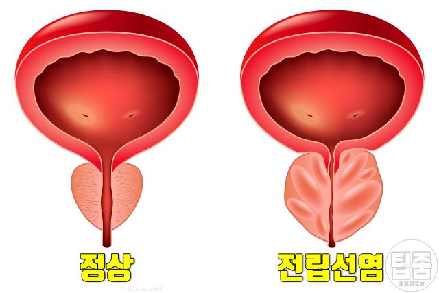 전립선 안좋을때 증상 타는느낌