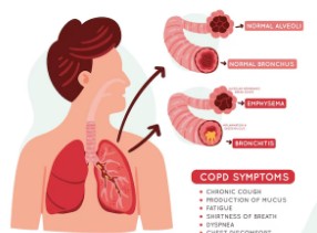 기관지염-증상-1