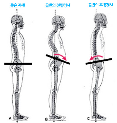 골반 경사의 설명 사진