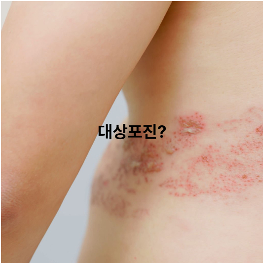 병원별 대상포진 예방접종 가격 차이