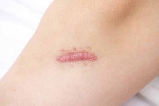 볼록한 흉터 (Hypertrophic Scars): 원인과 치료 방법