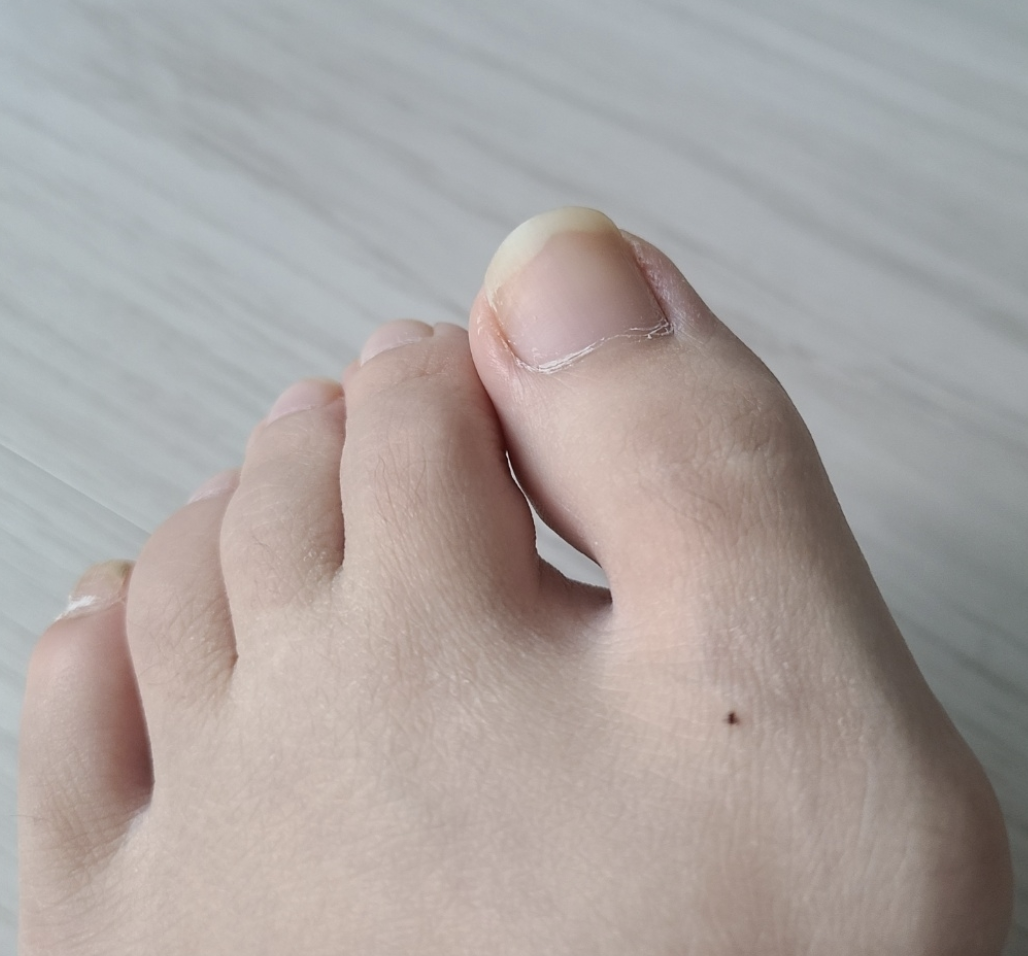 무지외반증