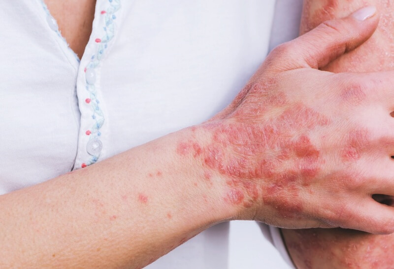 발진이-일어난-팔