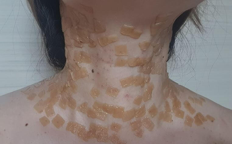 쥐젖 제거 후 모습