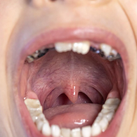 타석증_원인_증상_치료방법