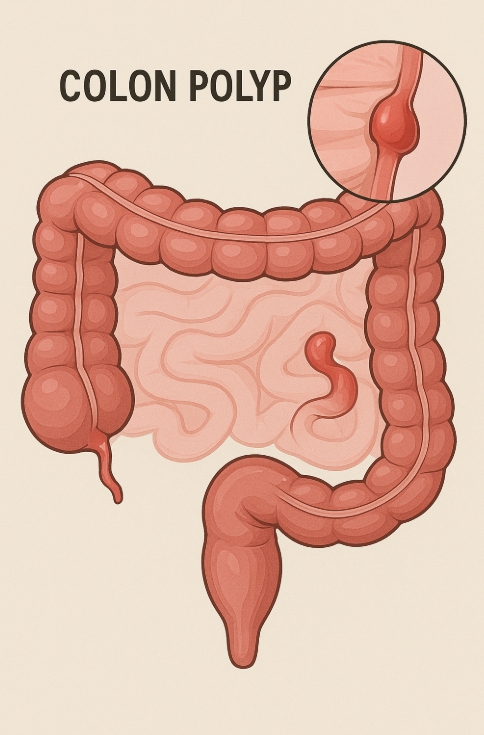 대장용종 관련 자료 사진