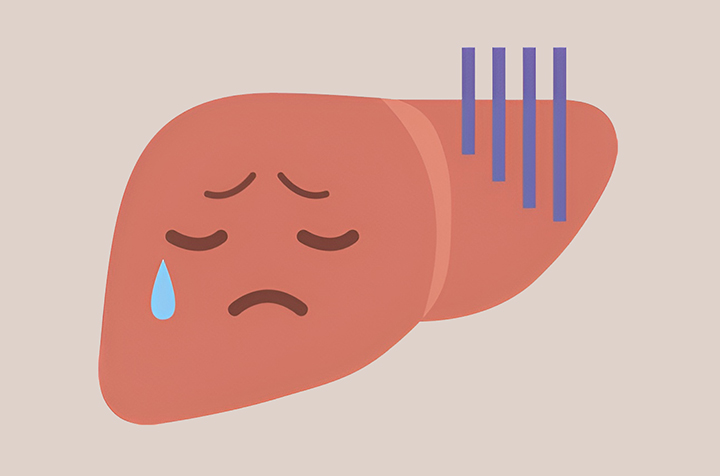 간질환이-있는-간모습
