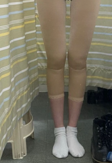 허벅지 지방흡입 후기